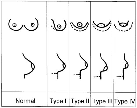 small pointy breasts|TUBEROUS BREAST DEFORMITY: PROBLEMS AND .